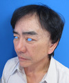 美容外科は女性のためだけのものではありません：Dr.近藤オリジナル　切らないお顔のたるみとり　チタンペックリフト　＆　ラディエッセ注入