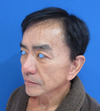 美容外科は女性のためだけのものではありません：Dr.近藤オリジナル　切らないお顔のたるみとり　チタンペックリフト　＆　ラディエッセ注入