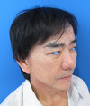 美容外科は女性のためだけのものではありません：Dr.近藤オリジナル　切らないお顔のたるみとり　チタンペックリフト　＆　ラディエッセ注入
