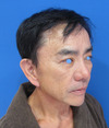 美容外科は女性のためだけのものではありません：Dr.近藤オリジナル　切らないお顔のたるみとり　チタンペックリフト　＆　ラディエッセ注入
