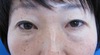 年末年始のお休み　プチ整形で若返って素敵になりませんか。　術直後でも内出血や腫れは最小限・DR近藤オリジナル　切らない目の下のくま・たるみとり　術直後写真　