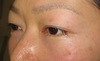 年末年始のお休み　プチ整形で若返って素敵になりませんか。　内出血や腫れは最小限・DR近藤オリジナル　切らない目の下のくま・たるみとり　術直後写真