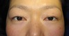 年末年始のお休み　プチ整形で若返って素敵になりませんか。　内出血や腫れは最小限・DR近藤オリジナル　切らない目の下のくま・たるみとり　術直後写真