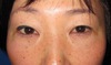 当院独自の極細専用糸・手術顕微鏡にて行う 「切らない二重術（切らない上まぶたのたるみとり）・Grace　埋没　二重術」術直後写真