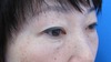 DR.近藤オリジナル　切らない　目の下のくま・たるみとり　 自己再生TCB  術後10日