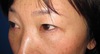 DR.近藤オリジナル　切らない　目の下のくま・たるみとり　 自己再生TCB  術後10日