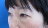 DR.近藤オリジナル　切らない　目の下のくま・たるみとり　 自己再生TCB  術後10日