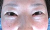 年末年始のお休み　プチ整形で若返って素敵になりませんか。　術直後でも内出血や腫れは最小限・DR近藤オリジナル　切らない目の下のくま・たるみとり　術直後写真　