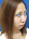 年末年始のお休み　プチ整形で若返って素敵になりませんか。内出血や腫れは最小限・ラディエッセ注入で、よりお綺麗に！鼻、チークの注入（直後写真）