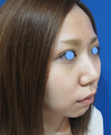 年末年始のお休み　プチ整形で若返って素敵になりませんか。内出血や腫れは最小限・ラディエッセ注入で、よりお綺麗に！鼻、チークの注入（直後写真）