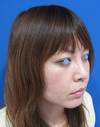 お顔なら何カ所でも何CCでも同一料金：DR近藤　美創り・PPPスペシャル：　内出血や腫れは最小限・自分の血液から作るジェルで若返り　PPP-GEL注入療法（目の下、チーク、法令線）