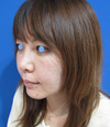 お顔なら何カ所でも何CCでも同一料金：DR近藤　美創り・PPPスペシャル：　内出血や腫れは最小限・自分の血液から作るジェルで若返り　PPP-GEL注入療法（目の下、チーク、法令線）