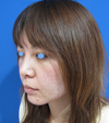 お顔なら何カ所でも何CCでも同一料金：DR近藤　美創り・PPPスペシャル：　内出血や腫れは最小限・自分の血液から作るジェルで若返り　PPP-GEL注入療法（目の下、チーク、法令線）