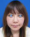 お顔なら何カ所でも何CCでも同一料金：DR近藤　美創り・PPPスペシャル：　内出血や腫れは最小限・自分の血液から作るジェルで若返り　PPP-GEL注入療法（目の下、チーク、法令線）