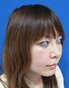 お顔なら何カ所でも何CCでも同一料金：DR近藤　美創り・PPPスペシャル：　内出血や腫れは最小限・自分の血液から作るジェルで若返り　PPP-GEL注入療法（目の下、チーク、法令線）