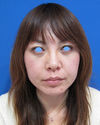 お顔なら何カ所でも何CCでも同一料金：DR近藤　美創り・PPPスペシャル：　内出血や腫れは最小限・自分の血液から作るジェルで若返り　PPP-GEL注入療法（目の下、チーク、法令線）