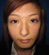 術直後でも内出血はありません。腫れもこの程度！プチ整形　幅広平行型二重術　術直後写真：当院独自の極細糸と顕微鏡を使った繊細なGRACE埋没二重術
