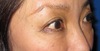 切らないで　目の下のクマ・たるみを改善！　DR.近藤オリジナル　切らない目の下のクマ・たるみとり　TCB-R　（膨らみと　凹みの混在した方に）