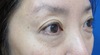 切らないで　目の下のクマ・たるみを改善！　DR.近藤オリジナル　切らない目の下のクマ・たるみとり　TCB-R　（膨らみと　凹みの混在した方に）