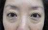 切らないで　目の下のクマ・たるみを改善！　DR.近藤オリジナル　切らない目の下のクマ・たるみとり　TCB-R　（膨らみと　凹みの混在した方に）