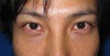 目の下のクマ・たるみでお悩みの方へ　ダウンタイムは最小限！！：DR近藤オリジナル　TCB-R　男性症例