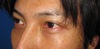 目の下のクマ・たるみでお悩みの方へ　ダウンタイムは最小限！！：DR近藤オリジナル　TCB-R　術後6週写真