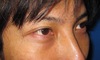目の下のクマ・たるみでお悩みの方へ　ダウンタイムは最小限！！：DR近藤オリジナル　TCB-R　男性症例