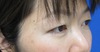 目の下のクマ・たるみでお悩みの方へ　ダウンタイムは最小限！！：DR近藤オリジナル　TCB-R　術後6週写真