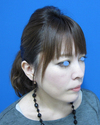 腫れ　内出血は　最小限！　プチ整形、たった数分で素敵美人に！！　DR近藤　こだわりのラディエッセ注入　（チーク、目の下、アゴ）