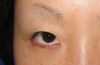 術直後でも内出血はありません。腫れもこの程度！プチ整形　幅広平行二重術　術直後写真：当院独自の極細糸と顕微鏡を使った繊細なGRACE埋没二重術