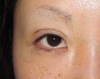 術直後でも内出血はありません。腫れもこの程度！プチ整形　幅広平行二重術　術直後写真：当院独自の極細糸と顕微鏡を使った繊細なGRACE埋没二重術
