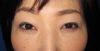 目の上下のたるみを全く傷を作らず、こんなに自然、綺麗に出来ますよ（切らない目の上・目の下のたるみとり）2ヶ月後写真
