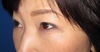 目の上下のたるみを全く傷を作らず、こんなに自然に　綺麗に出来ますよ（切らない目の上・目の下のたるみとり）2ヶ月後写真