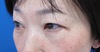 目の上下のたるみを全く傷を作らず、こんなに自然に　綺麗に出来ますよ（切らない目の上・目の下のたるみとり）2ヶ月後写真