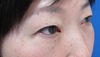 目の上下のたるみを全く傷を作らず、こんなに自然、綺麗に出来ますよ（切らない目の上・目の下のたるみとり）2ヶ月後写真