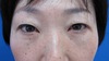 目の上下のたるみを全く傷を作らず、こんなに自然、綺麗に出来ますよ（切らない目の上・目の下のたるみとり）2ヶ月後写真