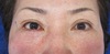 目の下の凹凸　他院手術後の修正治療　：切らない目の下のたるみとり応用　術直後写真