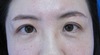 目の上のたるみ、自然な仕上がりで解決！術後1週写真：DR近藤　こだわりの眉下切開法　