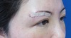 目の上のたるみ、自然な仕上がりで解決！術後1週写真：DR近藤　こだわりの眉下切開法　