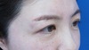 目の上のたるみ、自然な仕上がりで解決！術後1ヶ月写真：DR近藤　こだわりの眉下切開法　