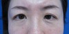 目の上のたるみ、自然な仕上がりで解決！術後1週写真：DR近藤　こだわりの眉下切開法　