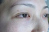 目の下のクマ・たるみでお悩みの方へ　ダウンタイムは最小限！！：DR近藤オリジナル　切らない目の下のくま、たるみとり　術直後写真